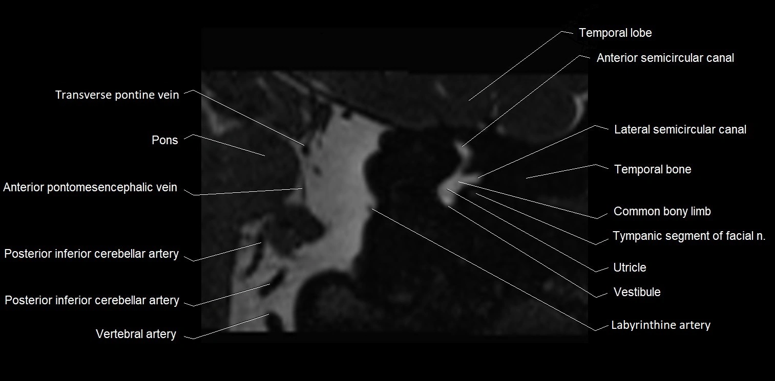 Internal auditory meatus (IAM) axial cross sectional anatomy image 19.webp
